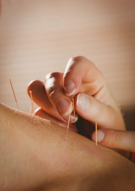 Young woman getting acupuncture treatment in therapy room