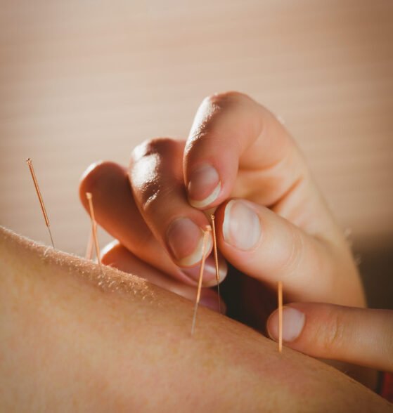 Young woman getting acupuncture treatment in therapy room